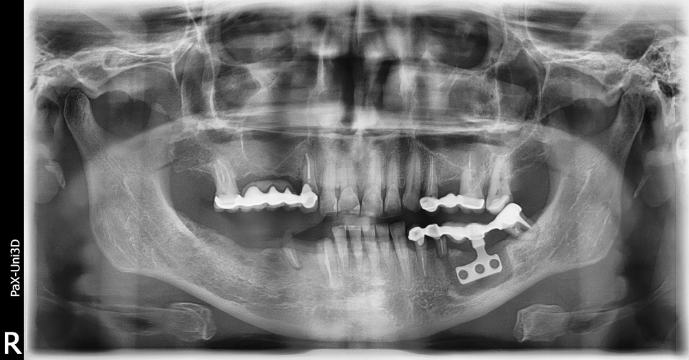 Базальна імплантація зубів