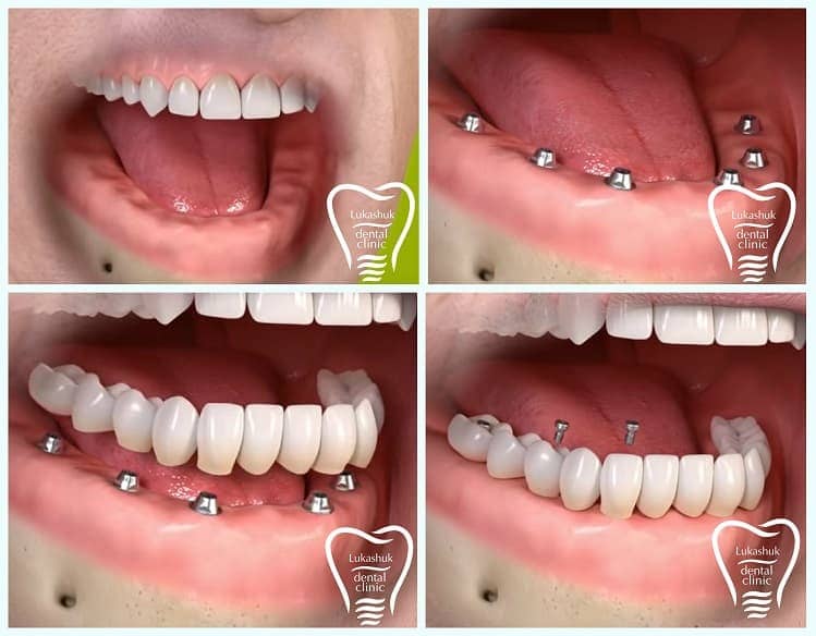 Етапи імплантації зубів - клиніка Лукашука