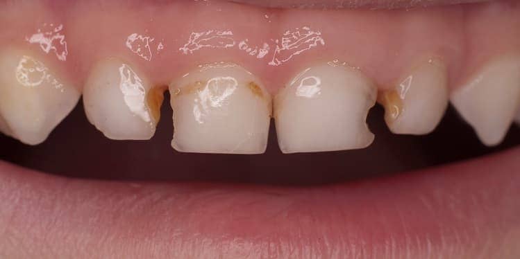 Кариес у детей - Лечение кариеса молочных зубов | Фото 1