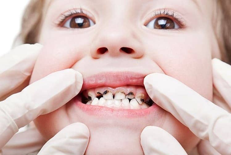 Кариес у детей - Лечение кариеса молочных зубов | Фото 2