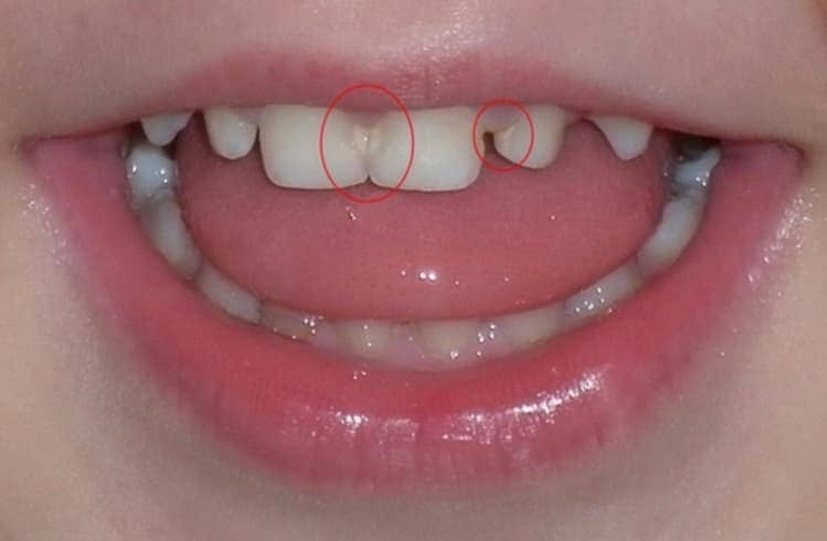 Карієс у дітей - Лікування карієсу молочних зубів | Фото 4