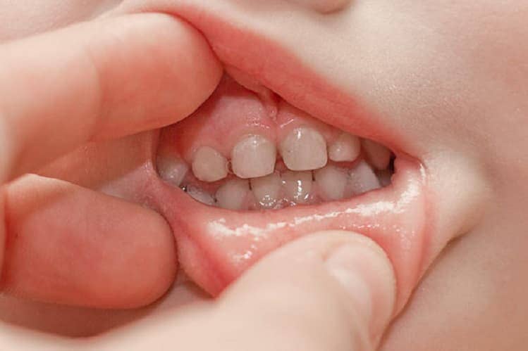 Карієс у дітей | Лікування карієсу молочних зубів Київ