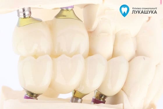 Протезування зубів на імплантах | Фото 4