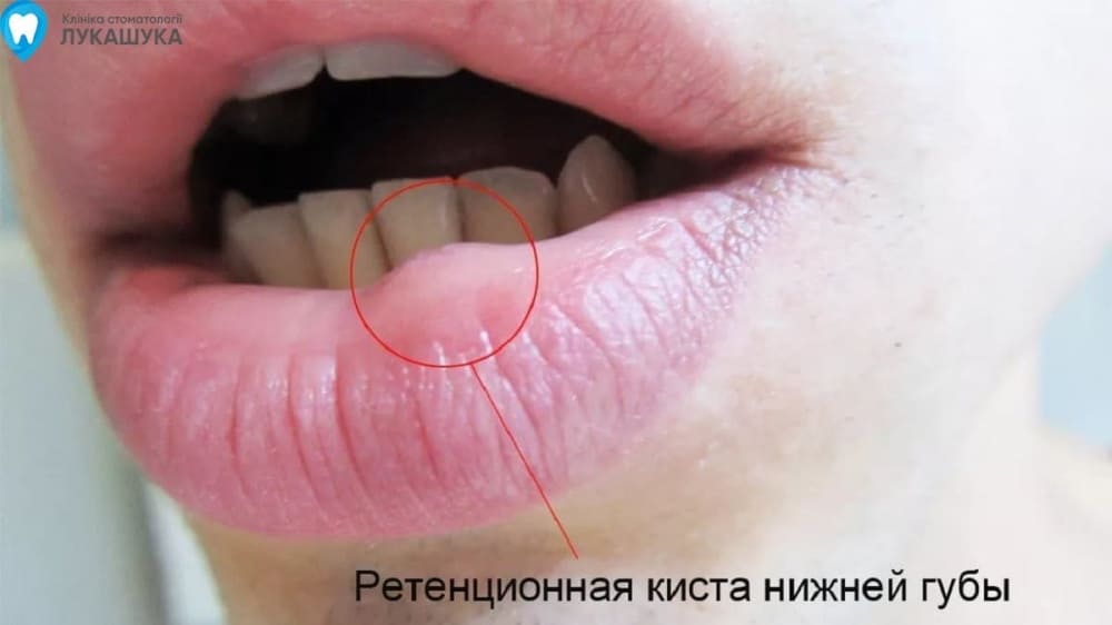Ретенционная киста нижней губы | Фото 1 - Клиника Лукашука