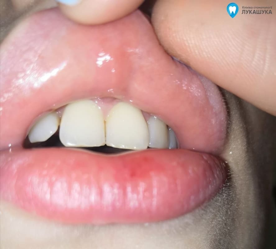 Кіста на губі, причини, насідки, лікування | Фото 3