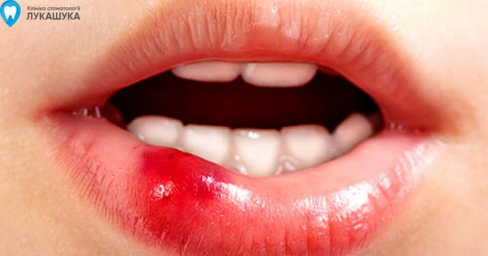 Ретенционная киста нижней губы | Фото 5 - Клиника Лукашука