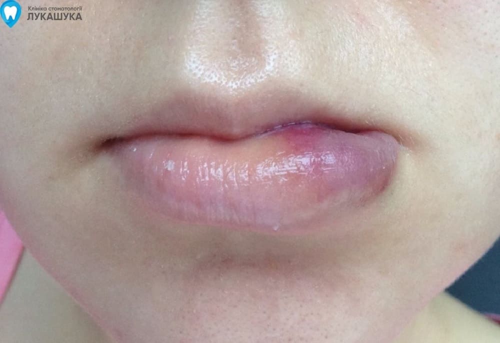 Ретенционная киста нижней губы | Фото 4 - Клиника Лукашука