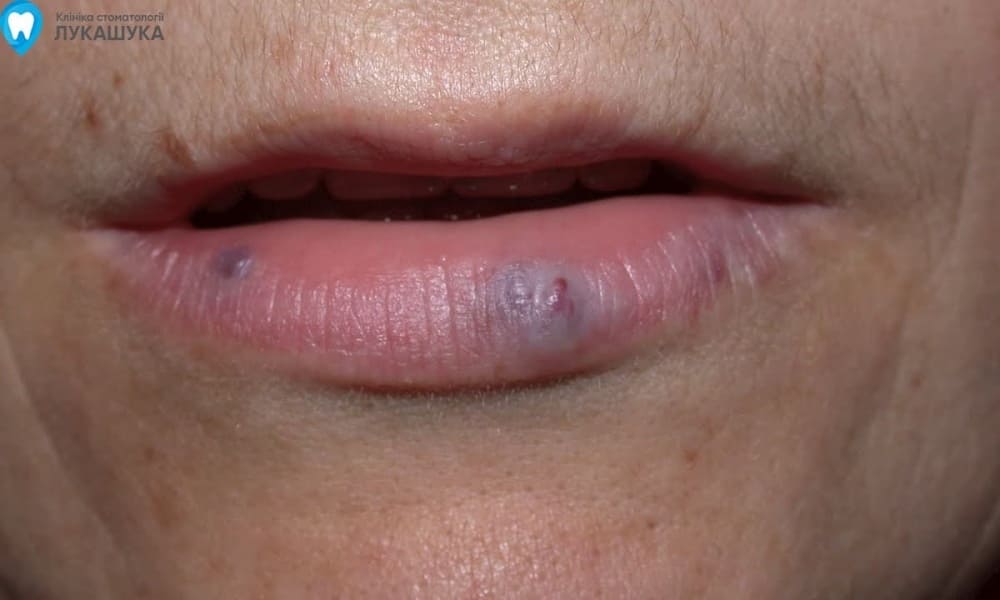 Ретенционная киста нижней губы | Фото 6 - Клиника Лукашука