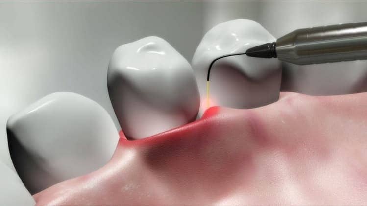 Лазерная имплантация зубов в Киеве | Фото 1