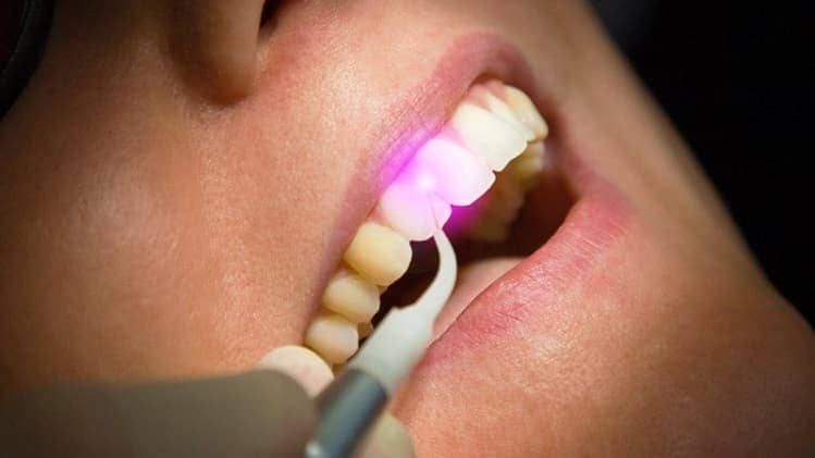 Лазерная имплантация зубов в Киеве | Фото 3