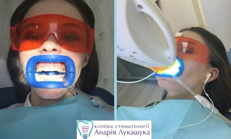 Відбілювання зубів ZOOM | Фото 6 - Клініка Лукашука