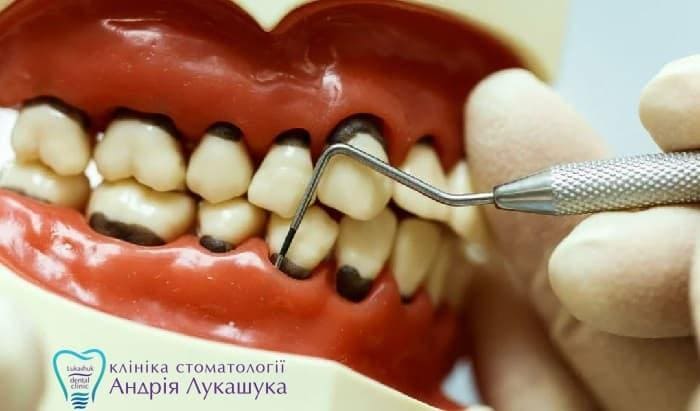 Лікування парадонтиту в клініці Лукашука - фото 6