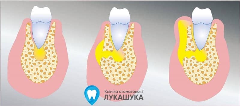 симптоми абсцесу зуба