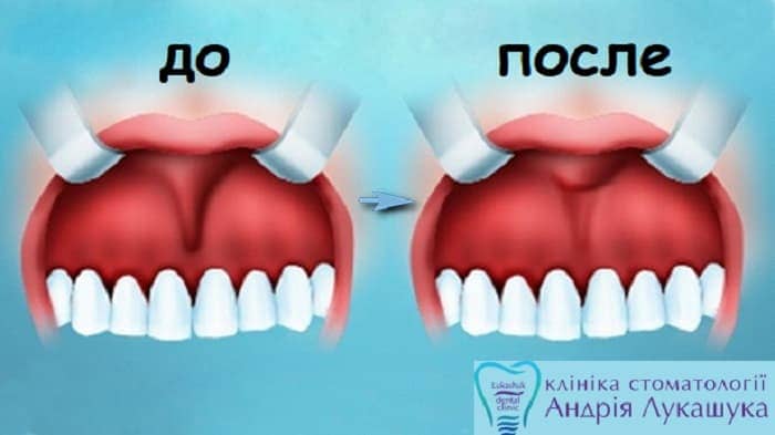 Пластика уздечки верхней губы | Фото 2 - Клиника Лукашука