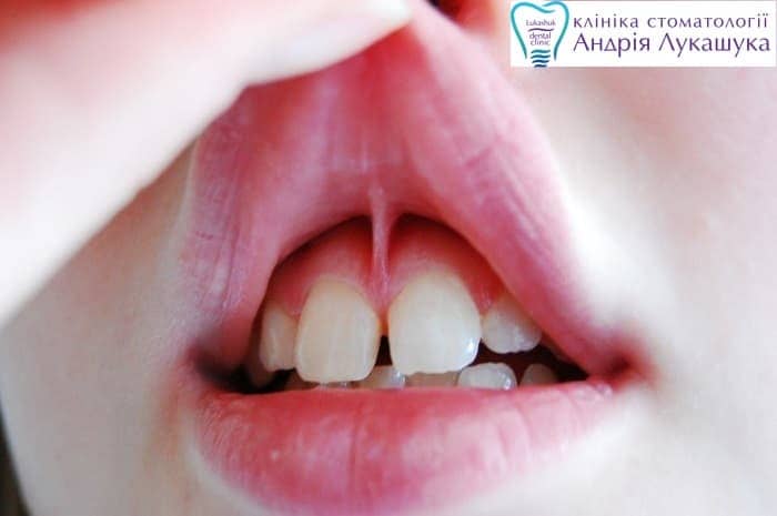 Пластика уздечки верхней губы | Фото 5 - Клиника Лукашука