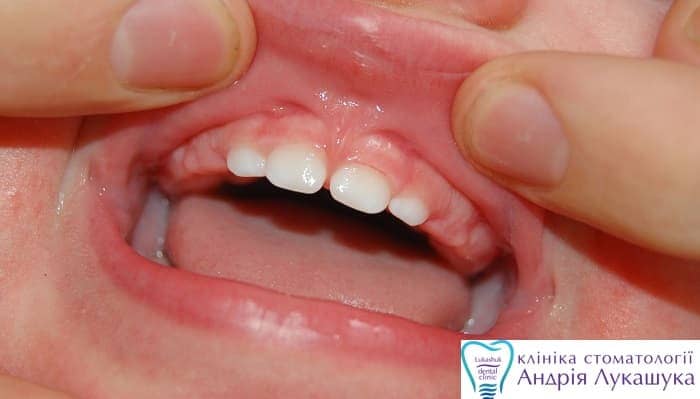 Пластика уздечки верхней губы | Фото 4 - Клиника Лукашука