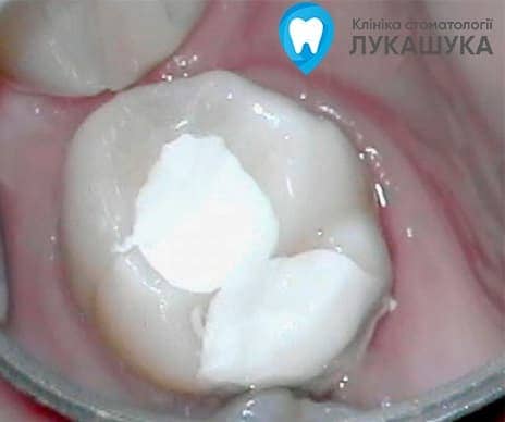 Пломбирование зубов - фото 3 - Клиника Лукашука