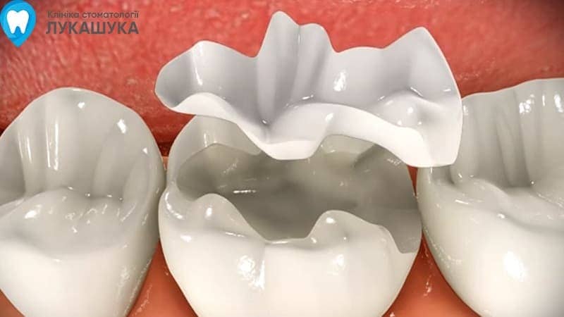 Пломбування зубів - фото 4 - Клініка Лукашука