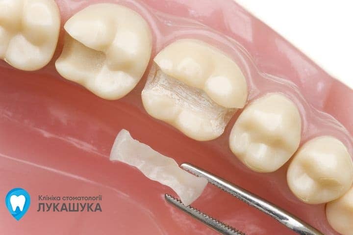 Пломбування зубів - фото 5 - Клініка Лукашука