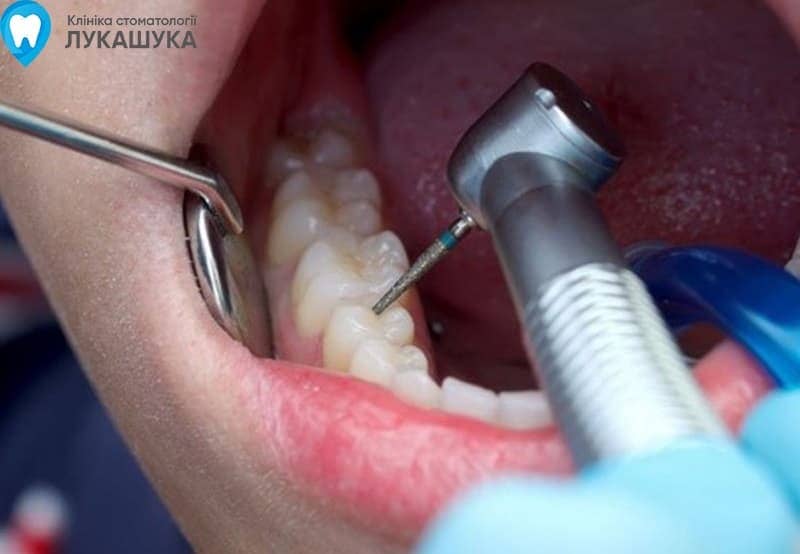 Пломбування зубів - фото 6 - Клініка Лукашука