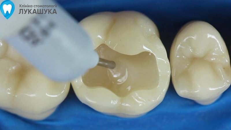 Пломбування зубів - фото 7 - Клініка Лукашука