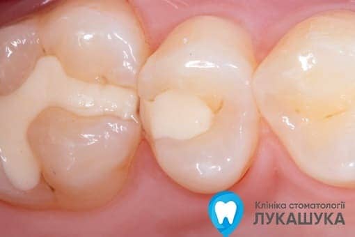 Пломбування зубів - фото 8 - Клініка Лукашука