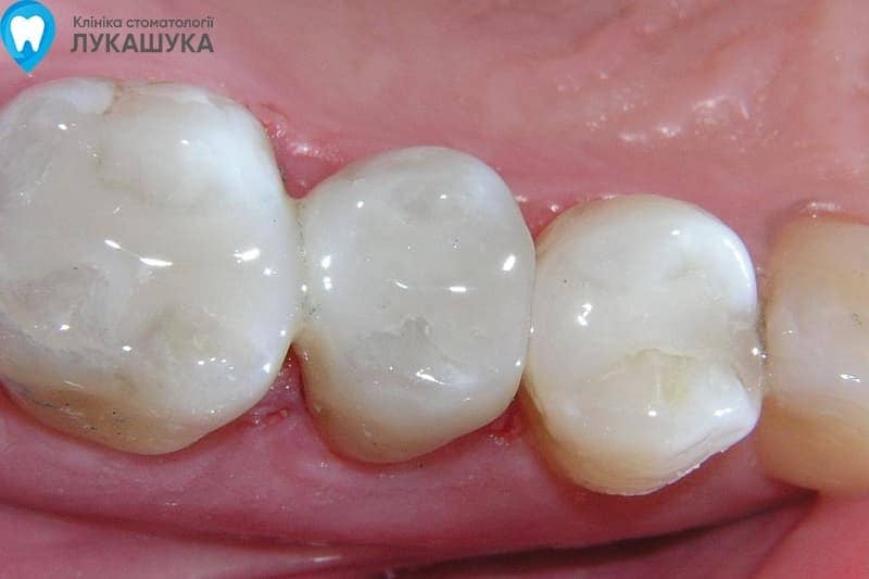 Пломбування зубів - фото 9 - Клініка Лукашука