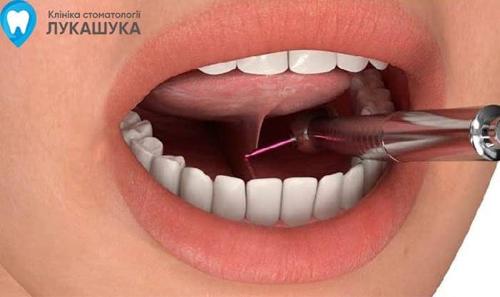 Підрізання вуздечки язика | Фото 1 - Клініка Лукашука