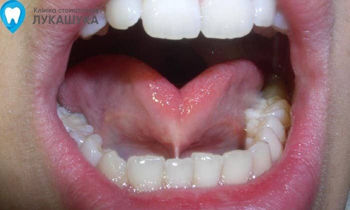 Підрізання вуздечки язика | Фото 5 - Клініка Лукашука