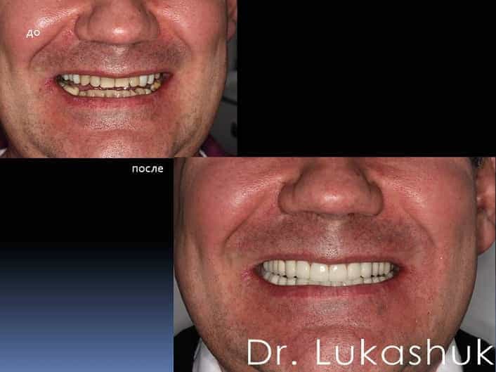 Реставрация зубов Киев | Пример 1