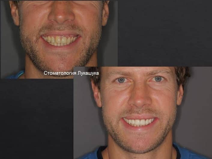 Реставрация зубов Киев | Пример 2