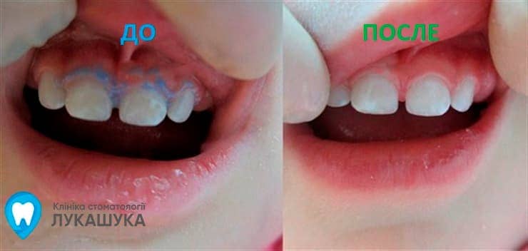 Серебрение зубов | Фото 3 - Клиника Лукашука