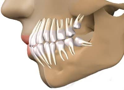Удаление зуба мудрости - фото 2 - клиника Лукашука