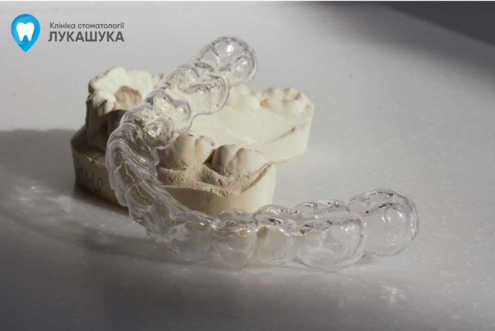 Вирівнювання зубів капами - Клініка Лукашука