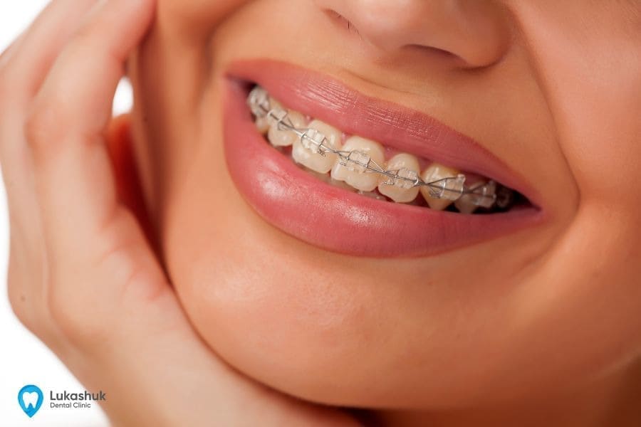 Выравнивание зубов брекетами - клиника Лукашука