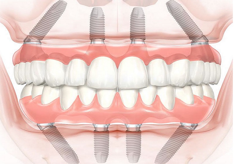 Имплантация всех зубов по технологии All-on-4