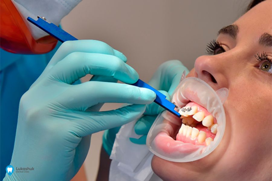 Фиксация расширителя рта | Фото 3 - Клиника Лукашука