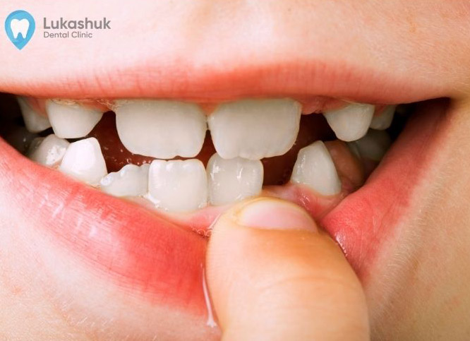Фото 2: Руйнування зубів у дитини