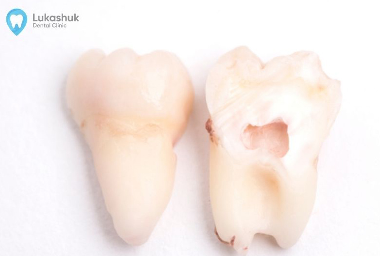 микротрещины в зубе