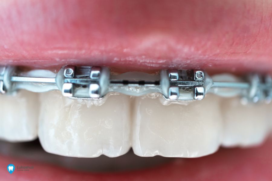 Брекет-система на зубы | Фото 2