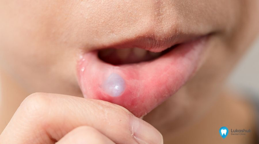 Кіста на губі, причини, насідки, лікування | Фото 1