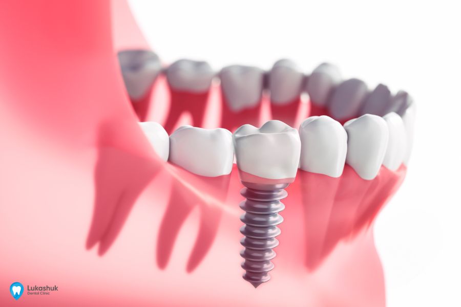 Точная установка зубного имплантата после КТ | Клиника Лукашука