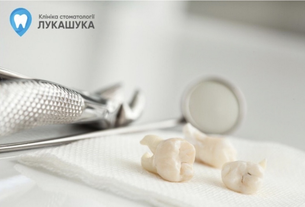 Лікування розхитаних зубів у клініці Лукашука