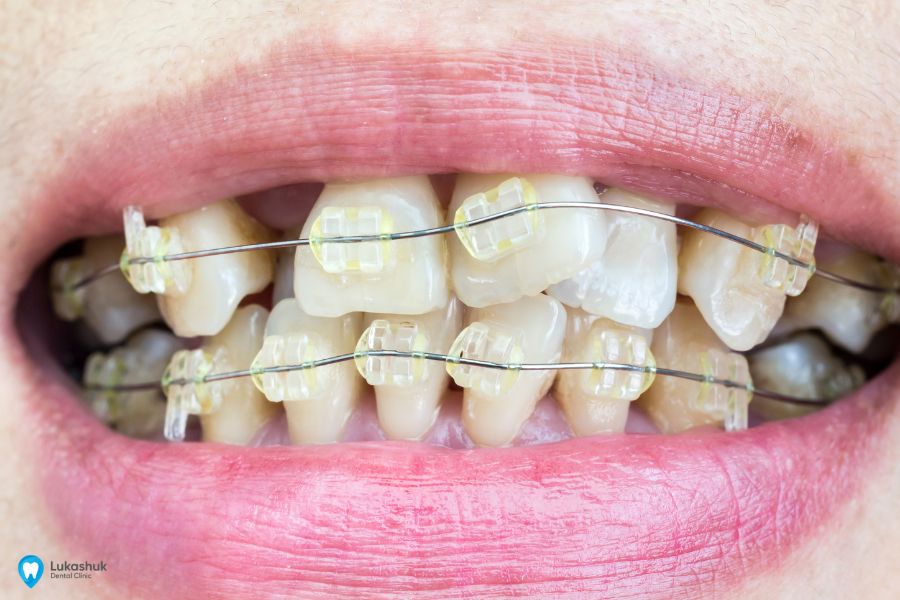 Нерівні зуби – Фото 2