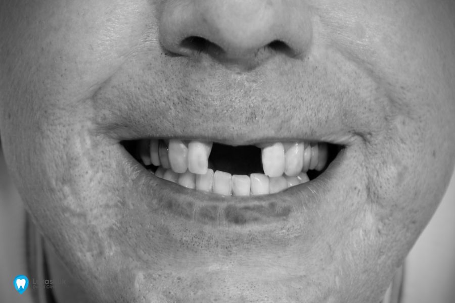 Рот без зубів - причина старіння
