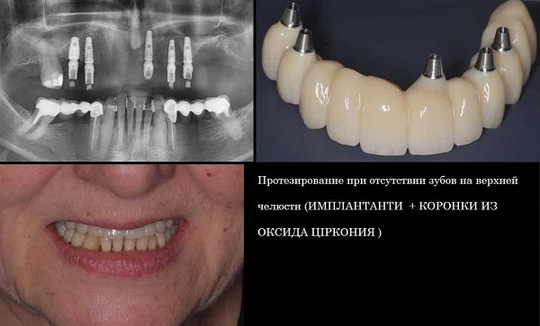 Пример имплантации зубов в стоматологии Лукашука в Киеве