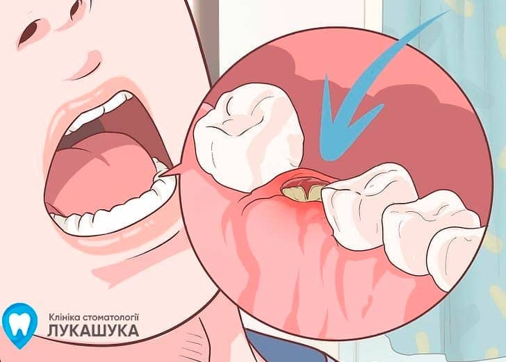 Альвеолит после удаления зуба | Фото 3 - Клиника Лукашука