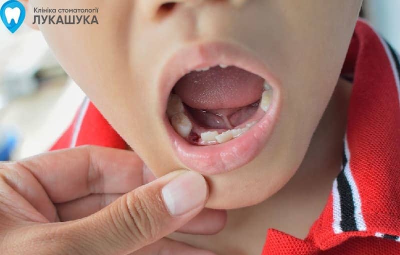 Альвеолит после удаления зуба | Фото 4 - Клиника Лукашука