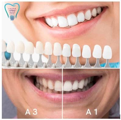 Белоснежная улыбка и здоровые зубы не одно и тоже | Фото 1 - Клиника Лукашука