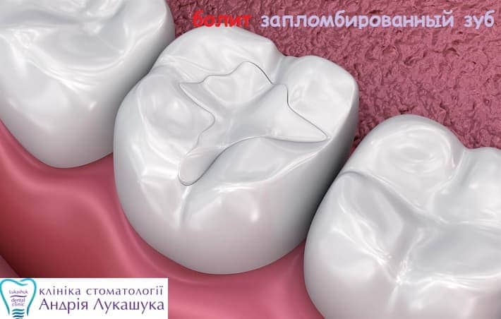 Болит запломбированный зуб - Клиника Лукашука